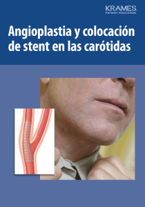 Angioplastia y colocación de stent en las carótidas