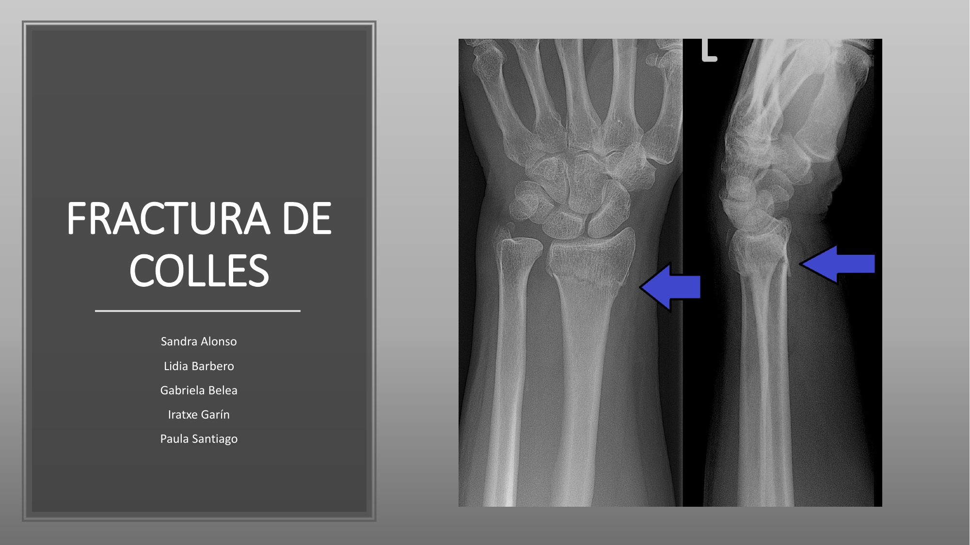 FRACTURA DE COLLES power Point 