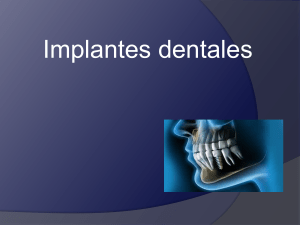 Implantes Dentales - Parte 1