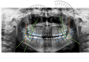 Análisis Radiográfico Dental: Terceros Molares